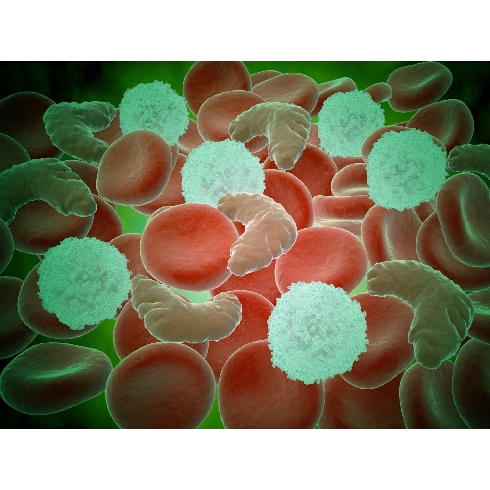 Posterazzi Sickle cell anemia with red blood cells and white bood cells Poster Print